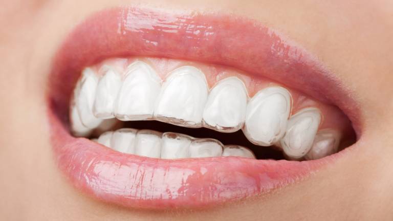 Clear Aligners